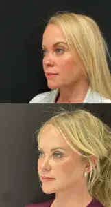 Facial Rejuvenation Before and After Patient Thumbnail 2