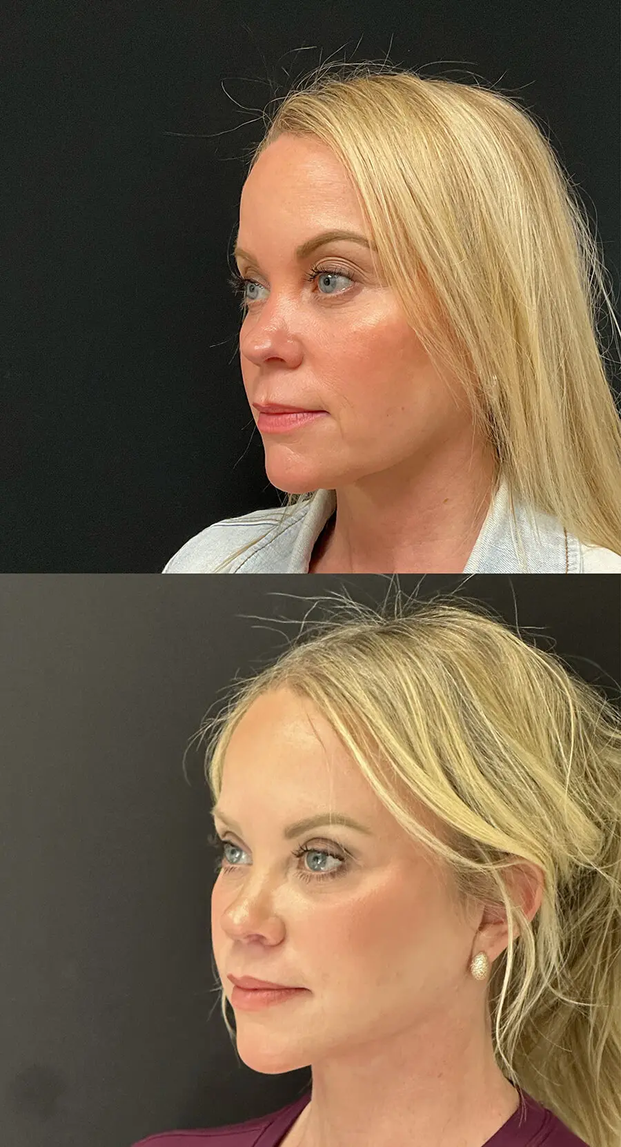 Facial Rejuvenation Before and After Patient 2