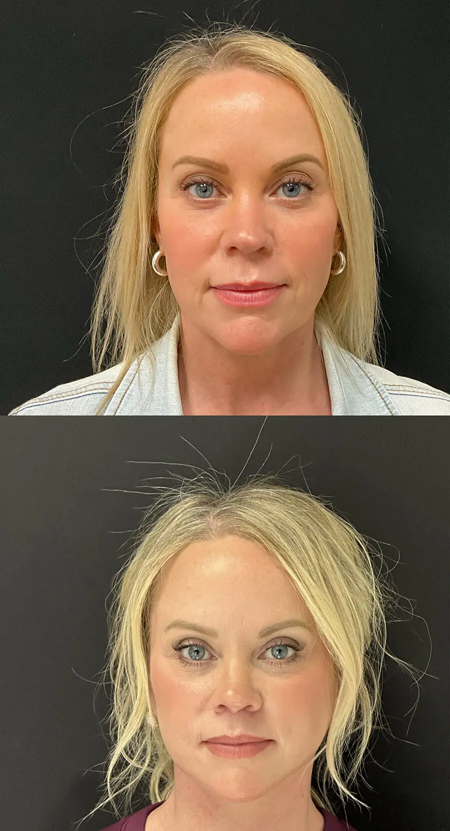 Facial Rejuvenation Before and After Patient 1