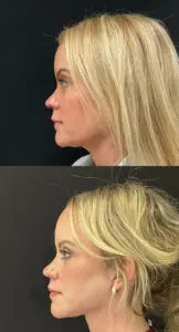 Facial Rejuvenation Before and After Patient Thumbnail 3