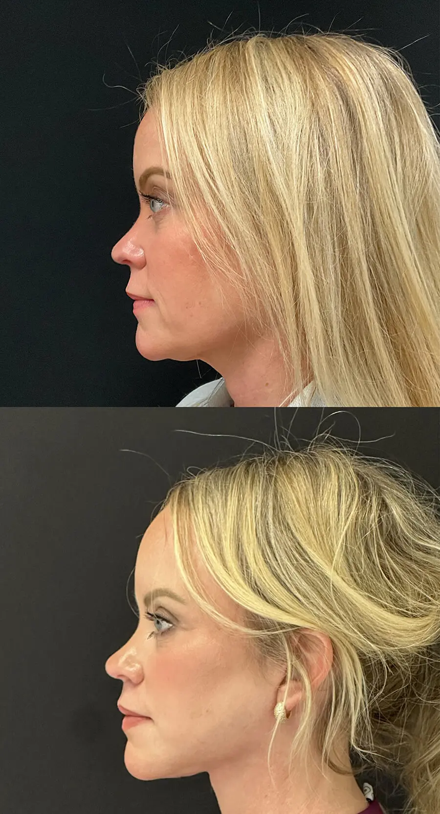Facial Rejuvenation Before and After Patient 3