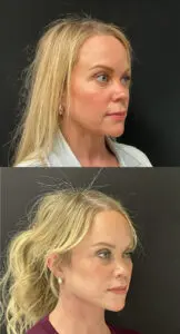 Facial Rejuvenation Before and After Patient Thumbnail 4