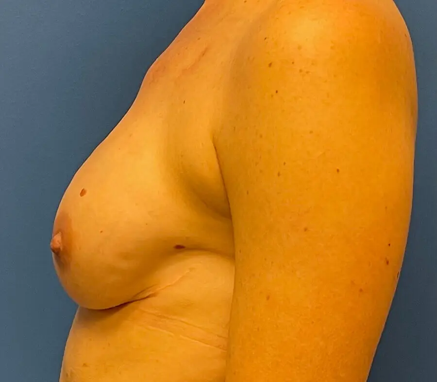 Breast Reconstruction Before and After Patient 3