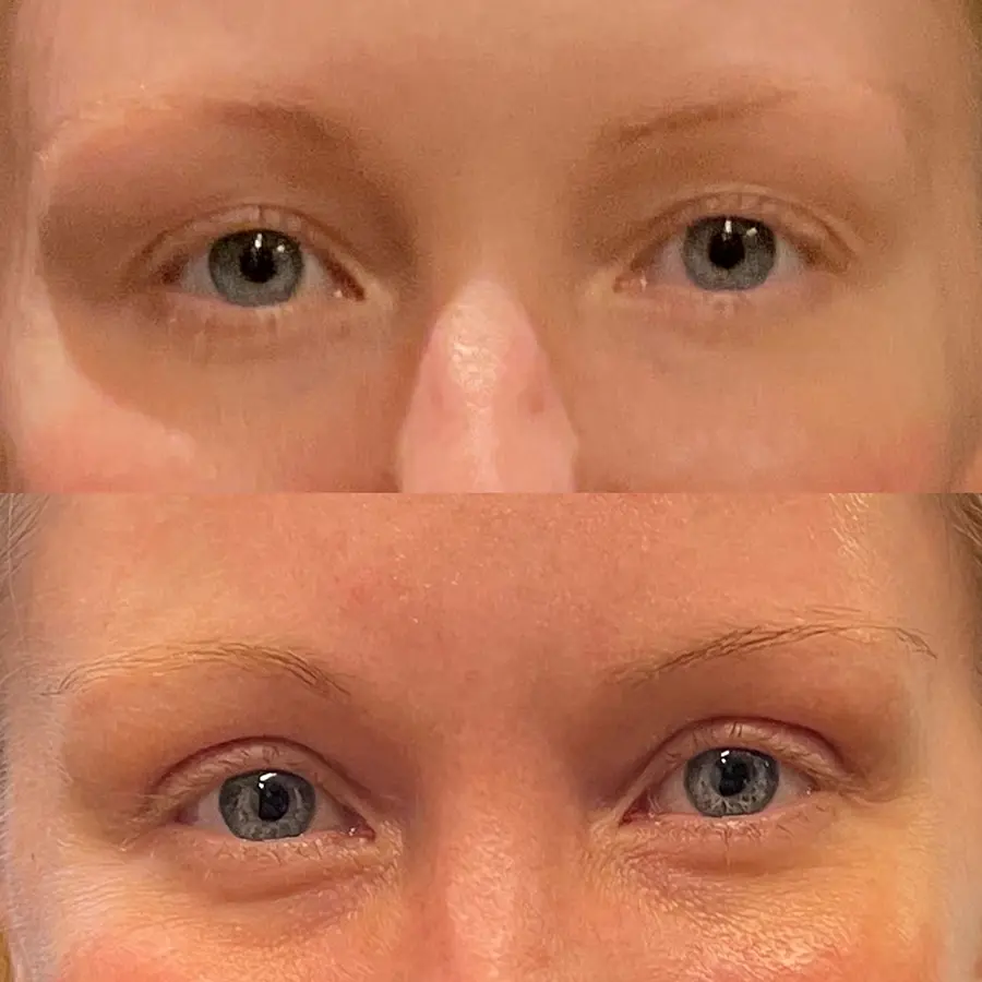 Eyelid Lift Before and After Patient 1