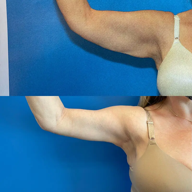 Body Before and After Patient 1