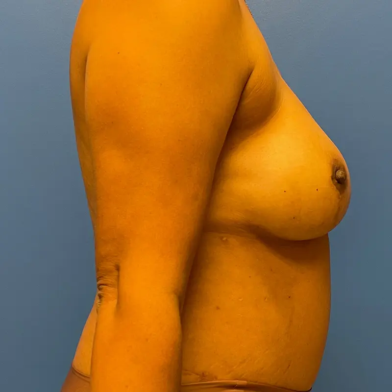 Breast Reconstruction Before and After Patient 2