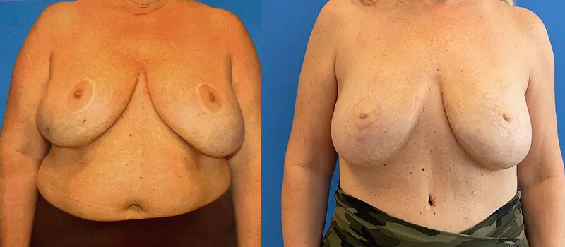 Breast Reconstruction Before and After Patient 1