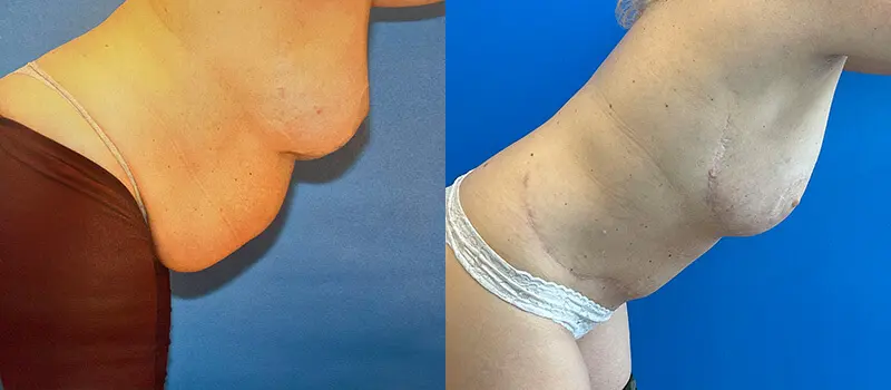 Breast Reconstruction Before and After Patient 3