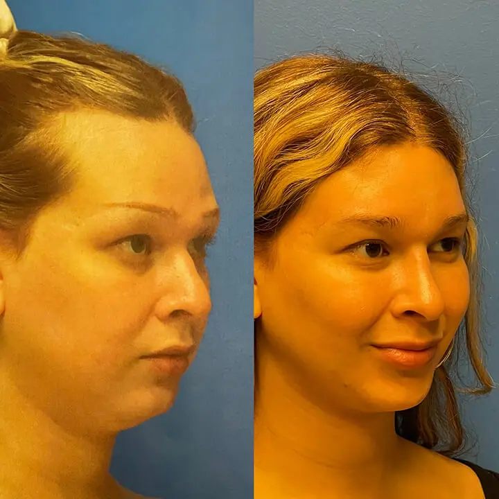 Face Before and After Patient 3