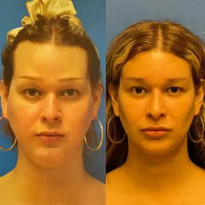 Face Before and After Patient Thumbnail 1