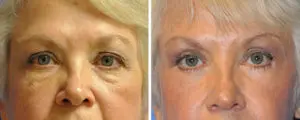 Eyelid Lift Before and After Patient Thumbnail 1