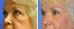 Eyelid Lift Before and After Patient Thumbnail 2