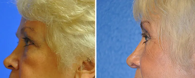Eyelid Lift Before and After Patient 3