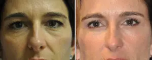 Eyelid Lift Before and After Patient Thumbnail 1