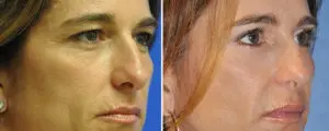 Eyelid Lift Before and After Patient Thumbnail 2