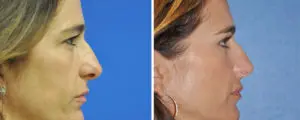Eyelid Lift Before and After Patient Thumbnail 3