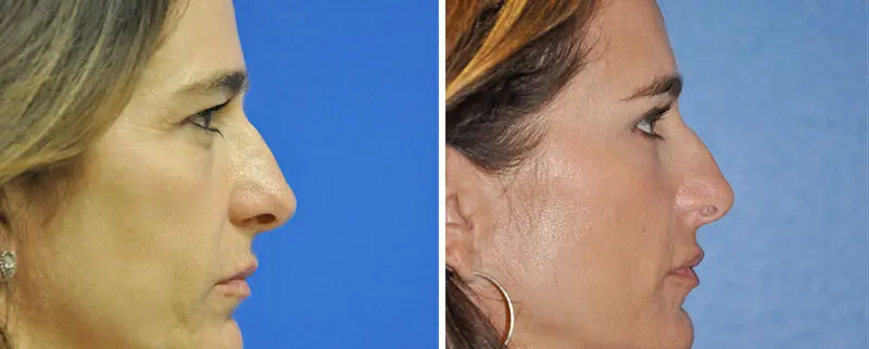 Eyelid Lift Before and After Patient 3