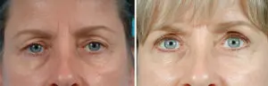 Eyelid Lift Before and After Patient Thumbnail 1