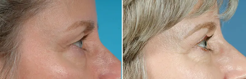 Eyelid Lift Before and After Patient 2