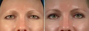Eyelid Lift Before and After Patient Thumbnail 1