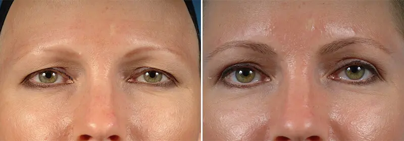 Eyelid Lift Before and After Patient 1