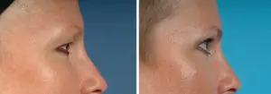 Eyelid Lift Before and After Patient Thumbnail 2