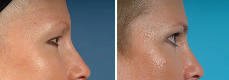 Eyelid Lift Before and After Patient 2