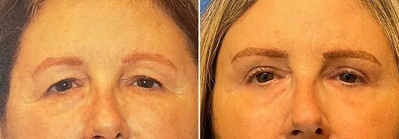 Eyelid Lift Before and After Patient 1