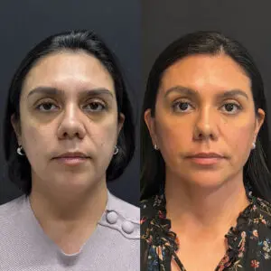Face Before and After Patient Thumbnail 1