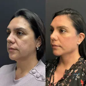 Face Before and After Patient Thumbnail 2