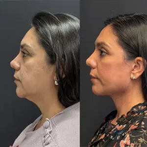Face Before and After Patient Thumbnail 3