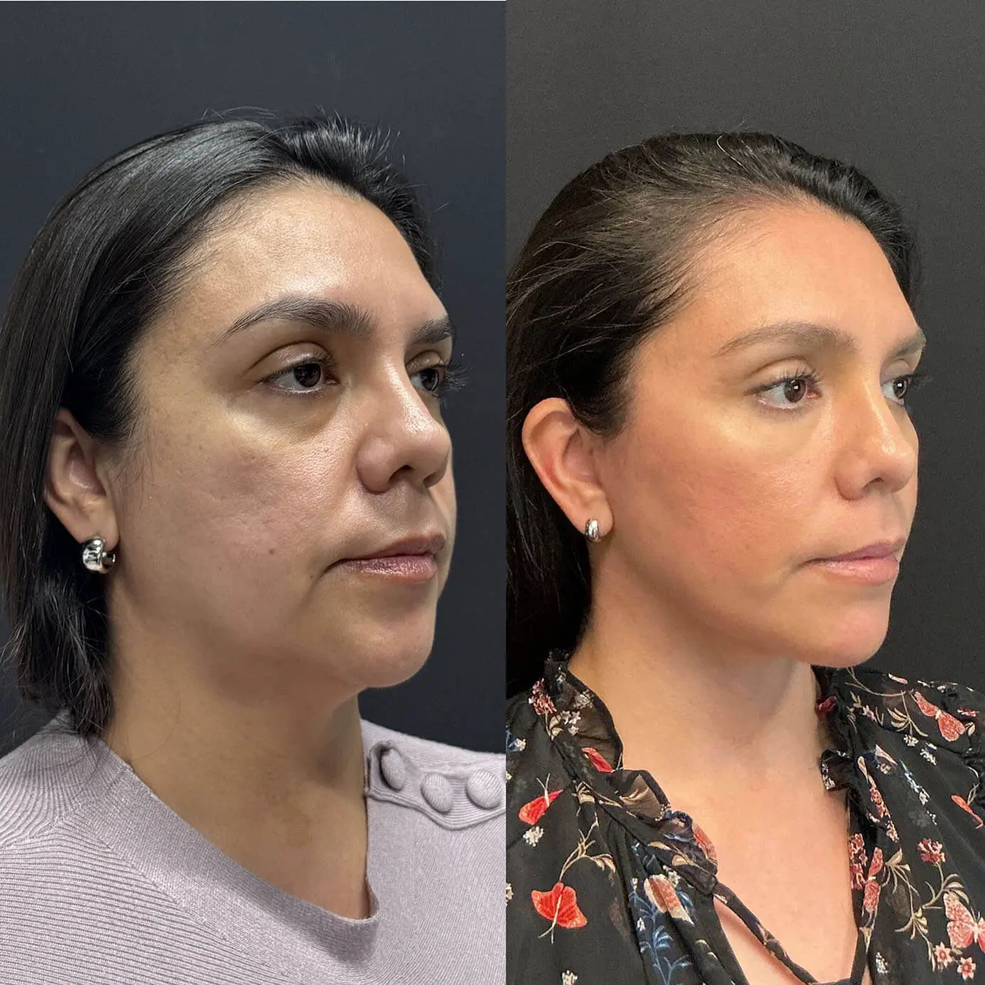 Face Before and After Patient 4