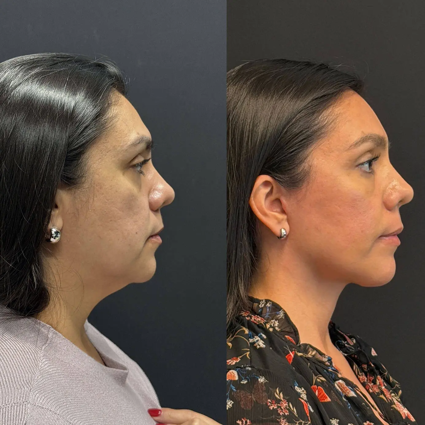 Face Before and After Patient 5
