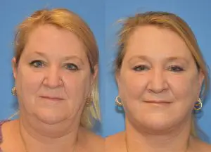 Facelift & Neck Lift Before and After Patient Thumbnail 1