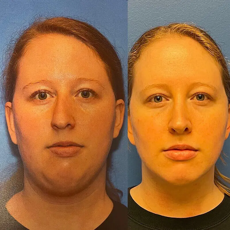 Neck Contouring Before and After Patient 1