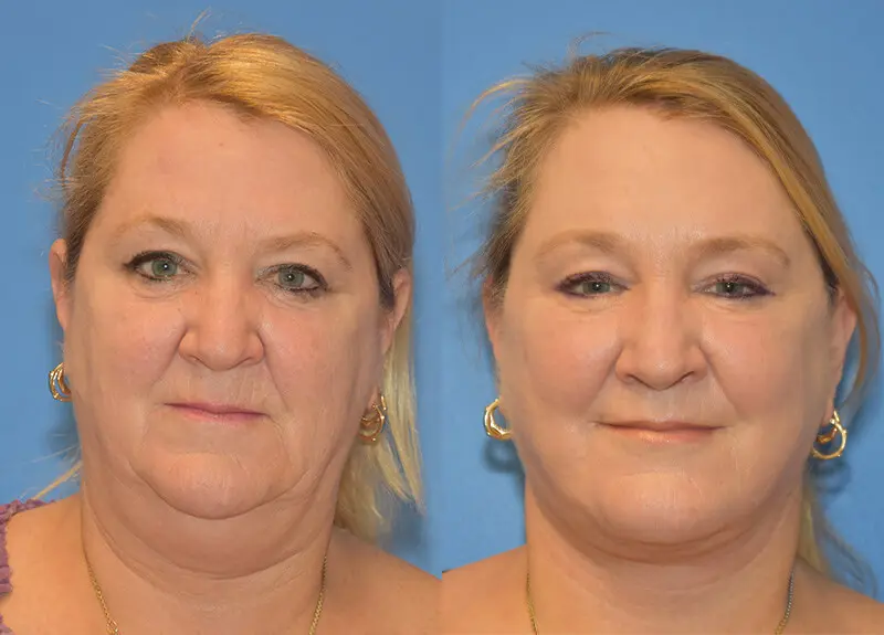 Facelift & Neck Lift Before and After Patient 1