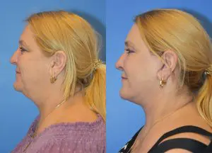 Facelift & Neck Lift Before and After Patient Thumbnail 2