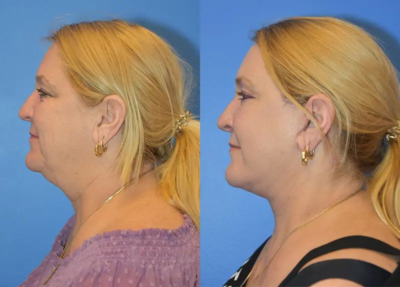 Facelift & Neck Lift Before and After Patient 2