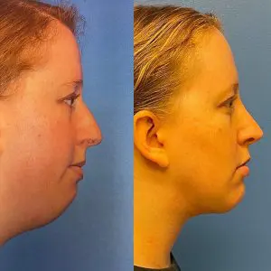 Neck Contouring Before and After Patient Thumbnail 3