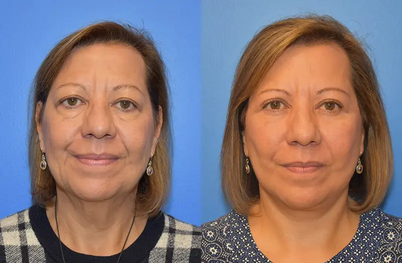 Facelift & Neck Lift Before and After Patient 1