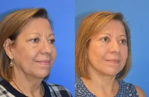 Facelift & Neck Lift Before and After Patient Thumbnail 2