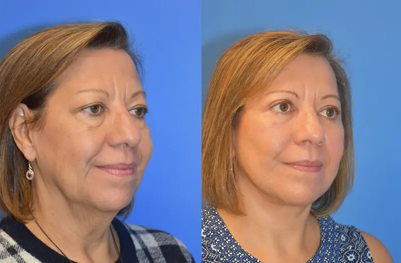 Facelift & Neck Lift Before and After Patient 2