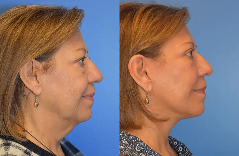 Facelift & Neck Lift Before and After Patient 3
