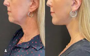Facelift & Neck Lift Before and After Patient Thumbnail 3