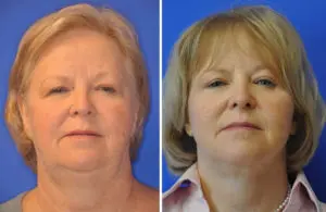 Facelift & Neck Lift Before and After Patient Thumbnail 2