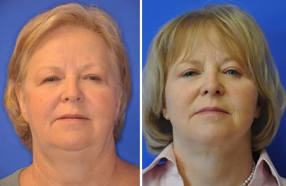 Facelift & Neck Lift Before and After Patient 2