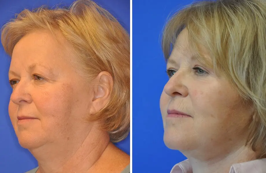 Facelift & Neck Lift Before and After Patient 3