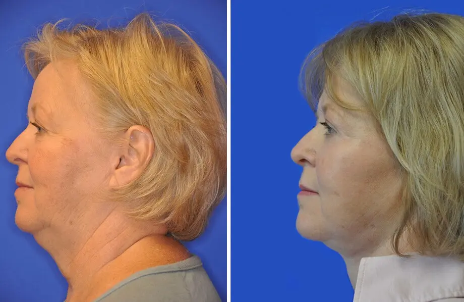 Facelift & Neck Lift Before and After Patient 1