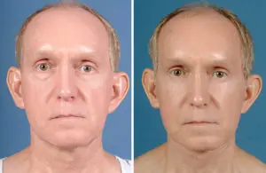 Facelift & Neck Lift Before and After Patient Thumbnail 3