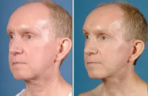 Facelift & Neck Lift Before and After Patient Thumbnail 4